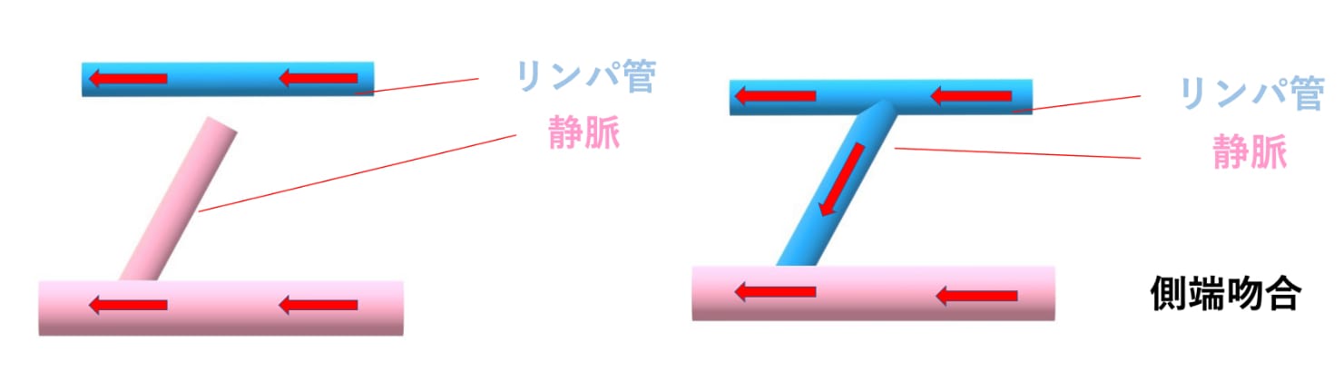 リンパ浮腫治療