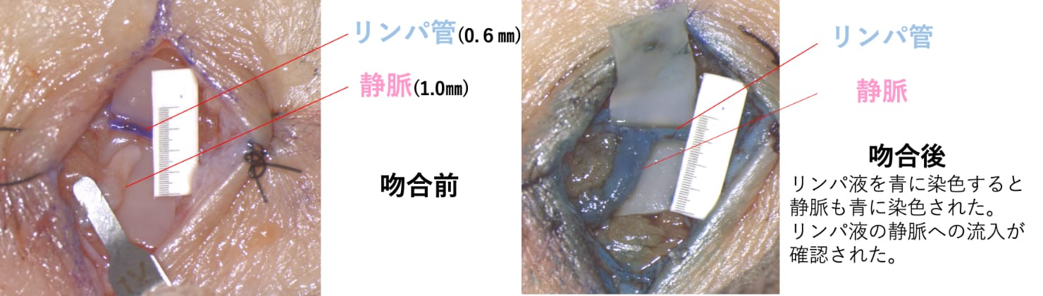 リンパ浮腫治療