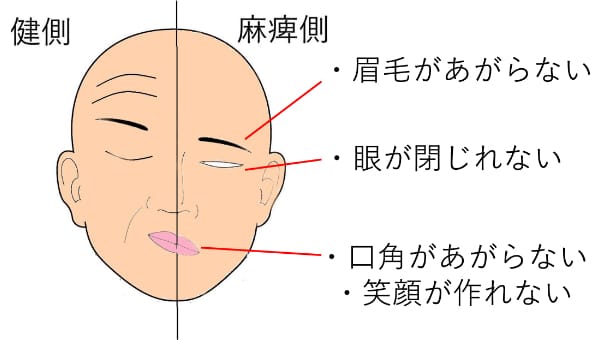 顔面神経麻痺の症状