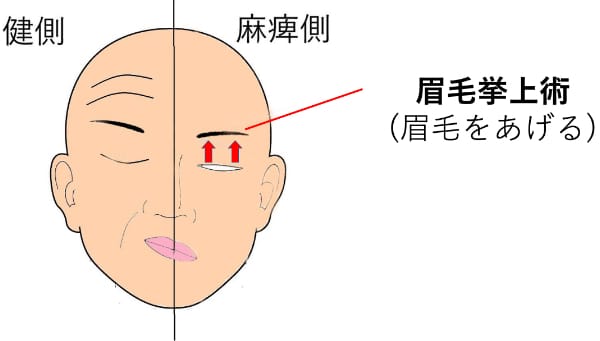 顔面神経麻痺の治療