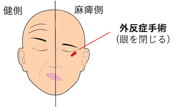 閉瞼不全/眼瞼外反症手術(静的再建)
