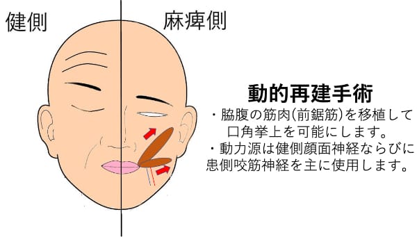 筋移植術(動的再建)