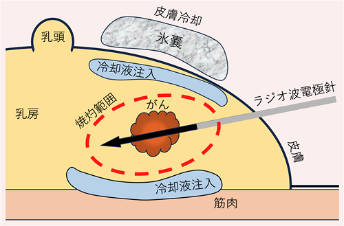 療法イメージ図